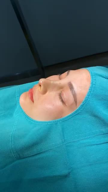 SỬA DÁNG MŨI LỖI CHO CHỊ KHÁCH HÀNG