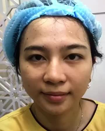 Cắt mí sau 7 ngày sẽ như thế nào? Cùng chiêm ngưỡng kết quả nhé.
