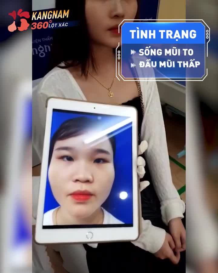 Vẫn là combo Cắt Mí + Nâng mũi "thần thánh" thay đổi 360 độ diện mạo đây ạ