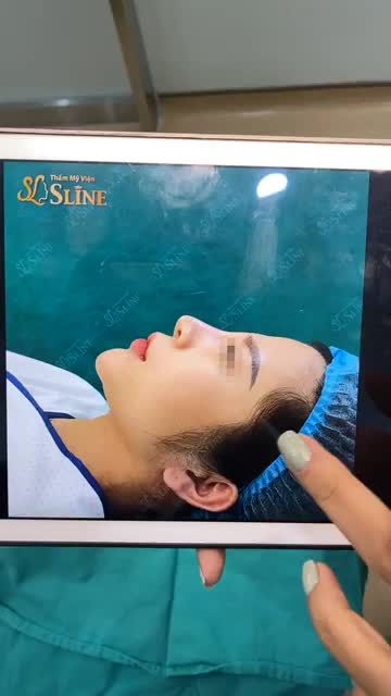 KHÁCH HÀNG ĐẾN SLINE VỚI TÌNH TRẠNG DÁNG MŨI LỖI ĐÃ NÂNG 2 LẦN TẠI CƠ SỞ KHÁC