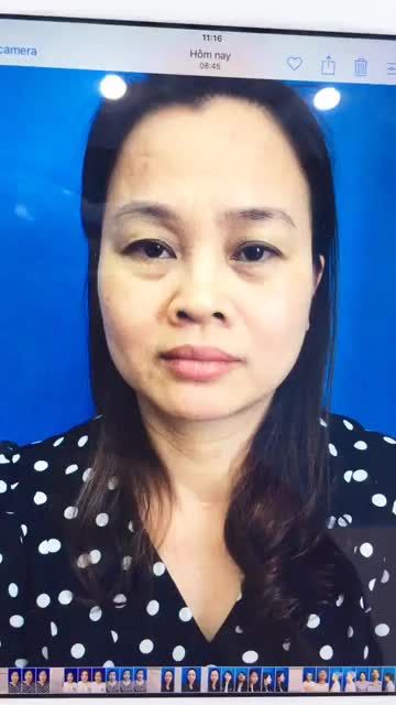 Thay đổi ngay sau Nâng cung mày tại thẩm mỹ viện Đông Á Hải Phòng 378 Tô Hiệu Ưu đãi -20%