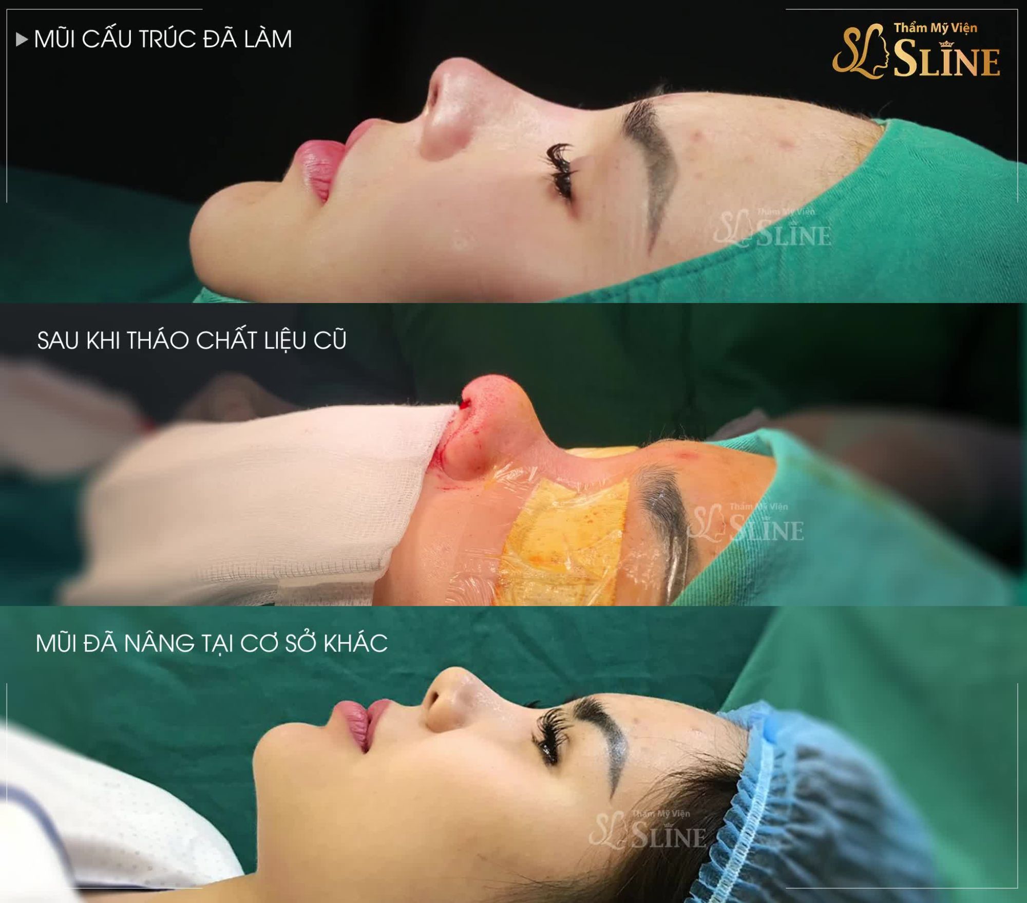 NÂNG MŨI CHƯA ƯNG Ý - ĐẾN SLINE LÀ HỢP LÝ