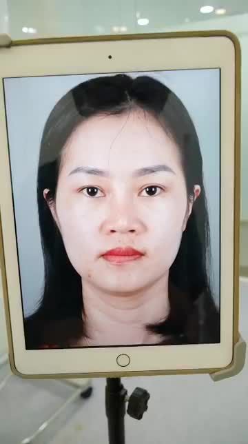 BÁC SĨ HOẠT VỪA THỰC HIỆN XONG MỘT CA NÂNG MŨI CẤU TRÚC SỤN SURGIFORM