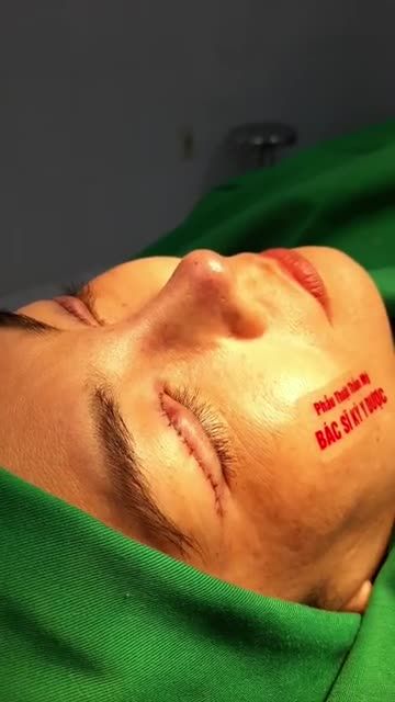CA NÂNG MŨI SỬA LẠI VÀ CẮT MẮT TRUNG HOA TẠI NHÀ BS KỲ Y DƯỢC