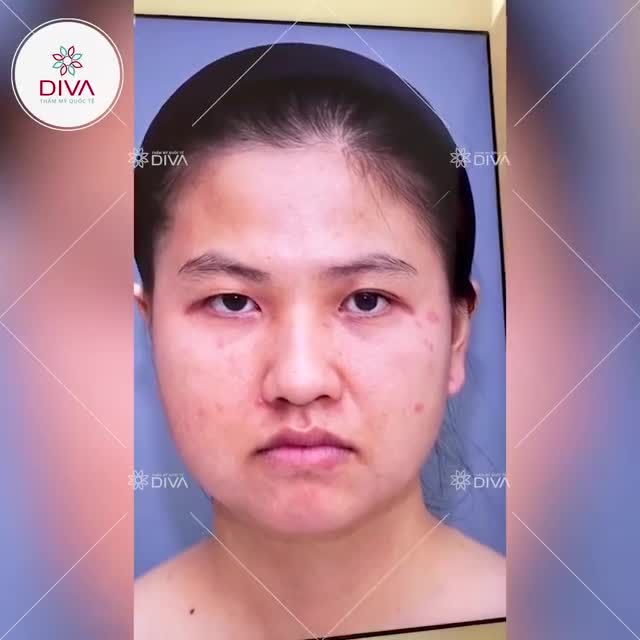 CẬN CẢNH KẾT QUẢ SAU CẮT MÍ MẮT DIVA