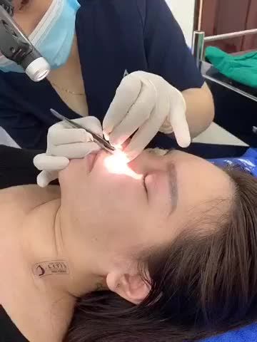Cắt chỉ sau khi sửa mũi được 10 ngày cho khách