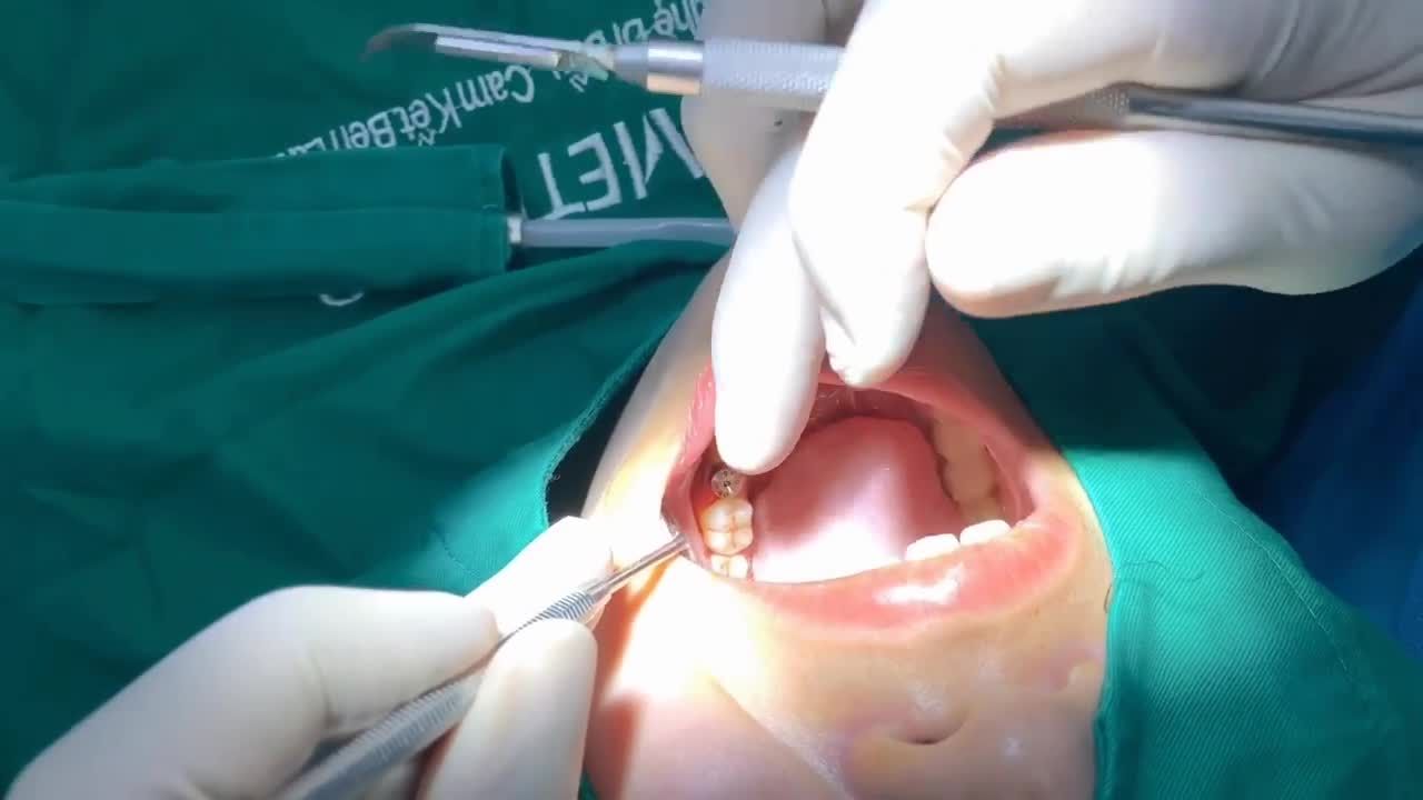 CẤY GHÉP IMPLANT R26 CHO KHÁCH HÀNG