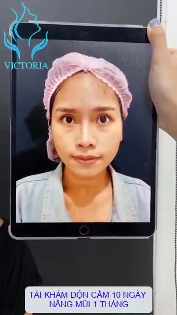 CÙNG NGẮM NHAN SẮC ĐẸP NGỠ NGÀNG SAU THỰC HIỆN COMBO NÂNG MŨI BÁN CẤU TRÚC + ĐỘN CẰM HÀN QUỐC