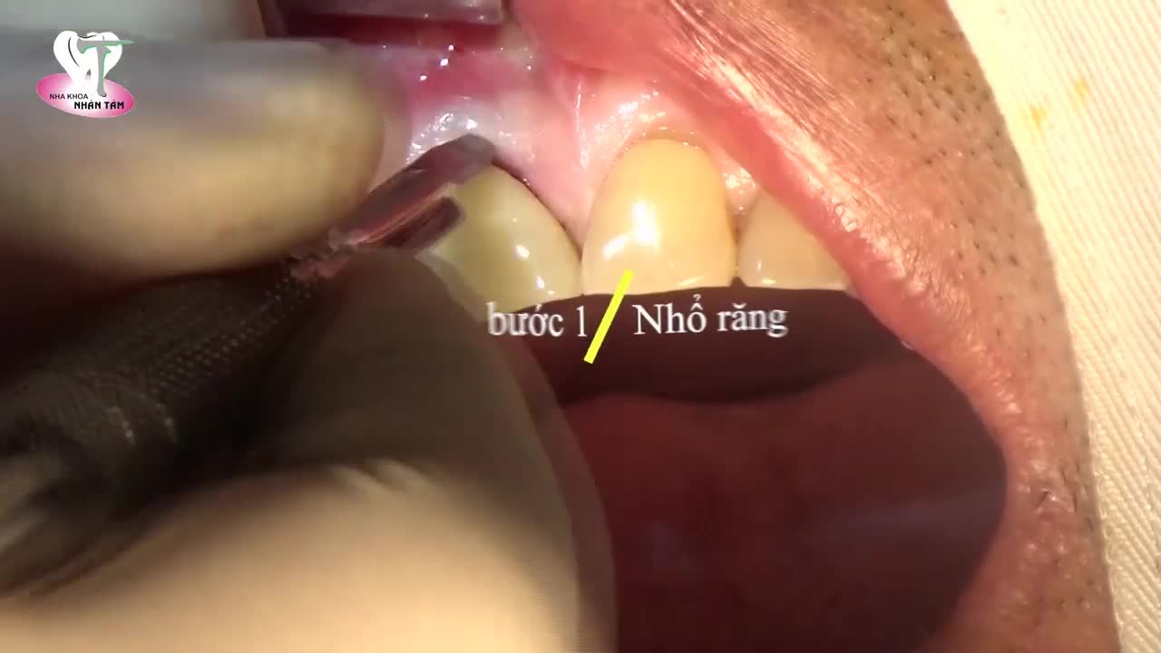 Khách hàng D.D.M – 56 tuổi, đến Nha khoa Nhân Tâm với tình trạng