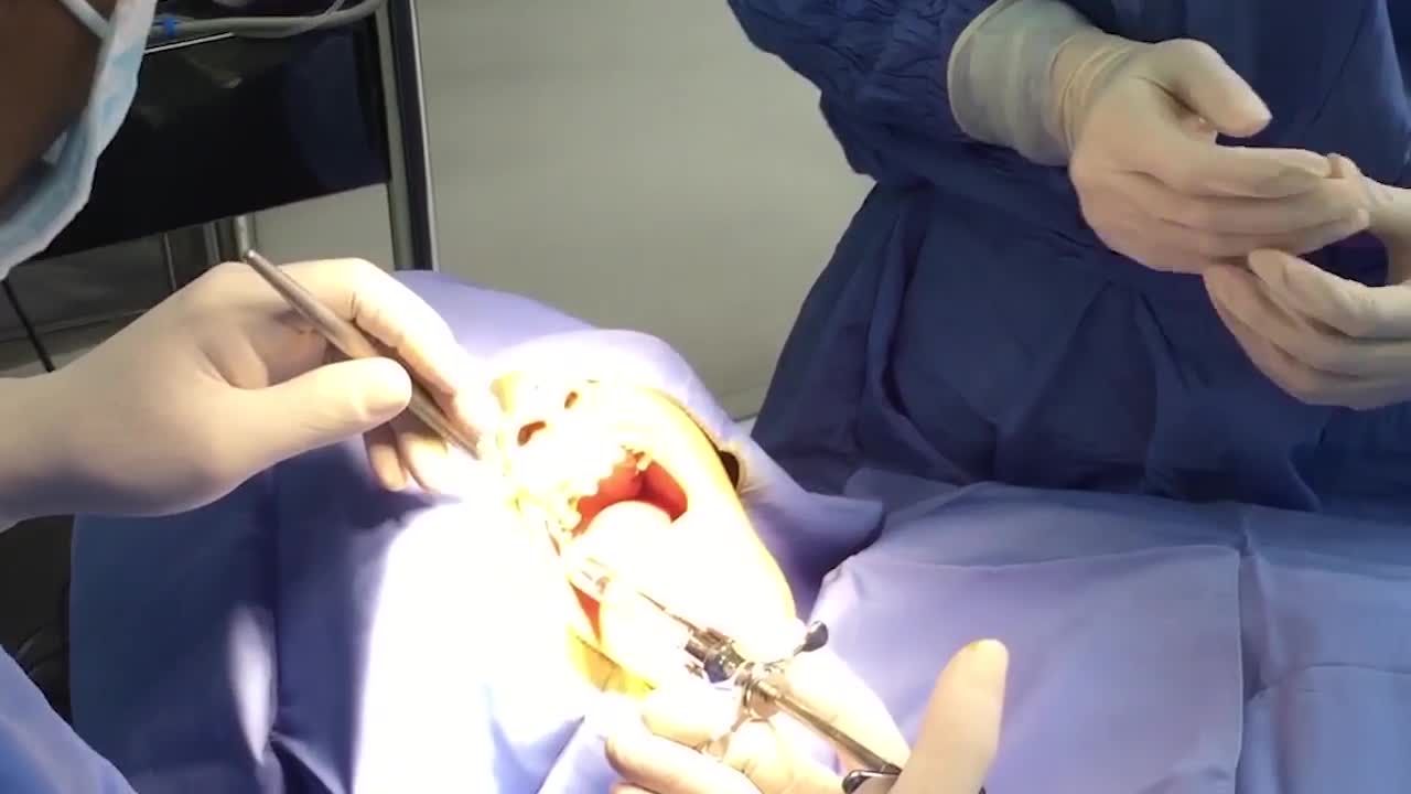 Khách hàng V.T.K (31 tuổi)-CẤY GHÉP 1 TRỤ IMPLANT HIOSSEN USA RĂNG 16