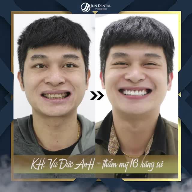 NỤ CƯỜI ĐẲNG CẤP TINH TẾ ĐẾN TỪ JUN DENTAL
