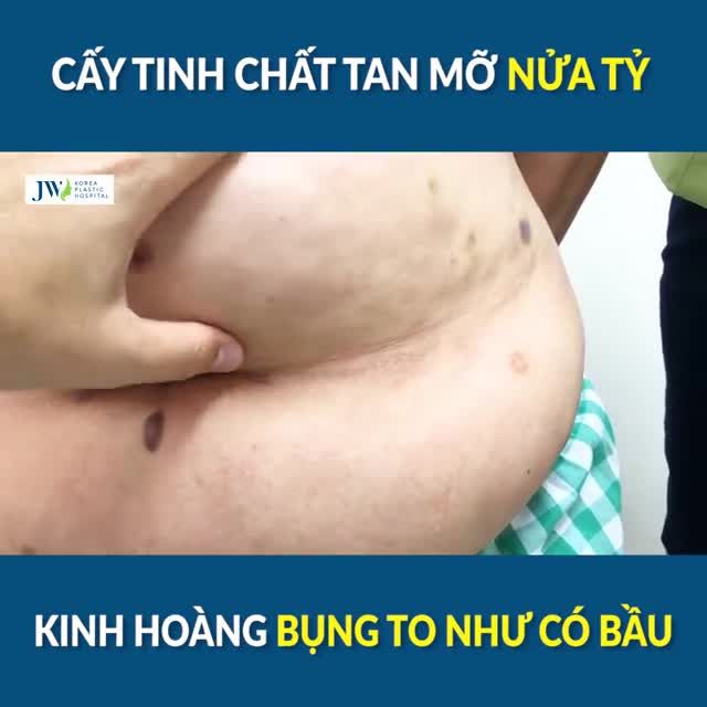 Bị lừa MẤT NỬA TỶ cấy tinh chất tan mỡ, nữ bệnh nhân MANG BỤNG TO NHƯ CÓ BẦU
