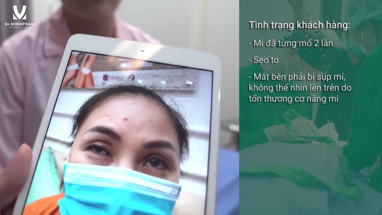 Ca Mí Sửa Siêu Khó tại Spa Cỏ và lời nhắn nhủ của vị khách hàng đến với chị em có ý định làm mí tại Spa !!