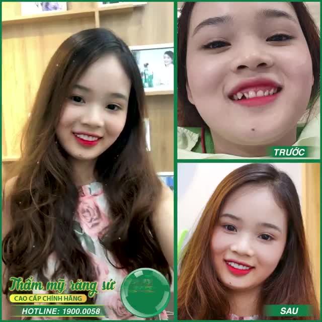 DÁN SỨ VENEER – SIÊU PHẨM LÀM ĐẸP KHÔNG MÀI NHỎ