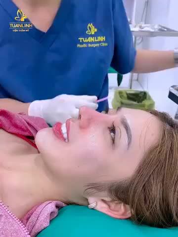 Khách hàng Nâng mũi tái cấu trúc sửa lại tái khám - tháo nẹp sau 10 ngày  ĐẸP XUẤT SẮC luôn nha mọi người.