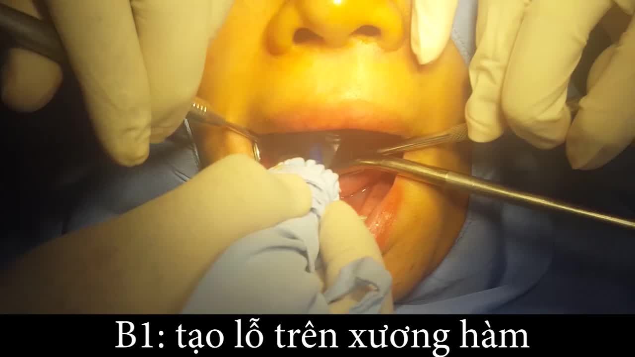 MẤT RĂNG SỐ 6 CÓ NÊN CẤY GHÉP IMPLANT
