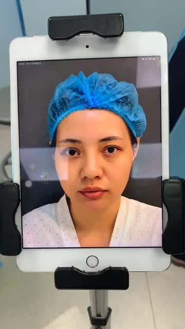 NÂNG MŨI CHO KHÁCH HÀNG ĐÃ TỪNG TIÊM FILER