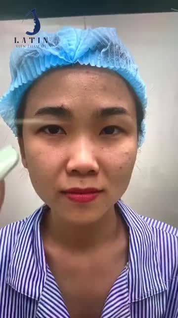Mũi thấp, ngắn, nền xương rộng Mũi không có sóng, ngắn hếch