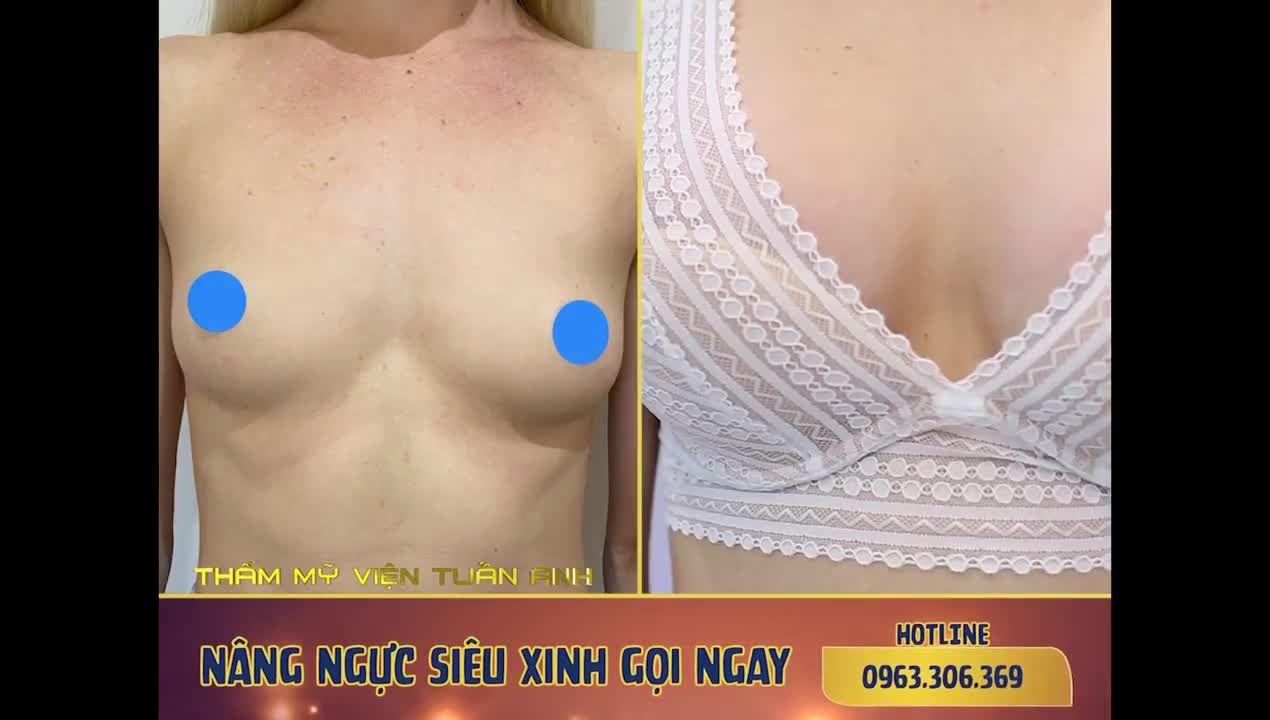 ƯU ĐÃI NGẬP TRÀN THÁNG 11 Hô biến sau 60’ với Thẩm Mỹ Tuấn Anh để thay đổi hoàn mỹ hơn