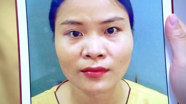 Mắt khó ở mực độ nào Dr.Hải Lê đều có thể khắc phục cho bạn