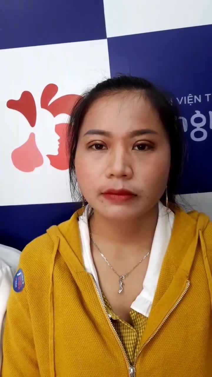 Mắt to tròn - mắt hai mí - nếp mí đều sau 7 ngày Cắt mí Plasma tại Kangnam