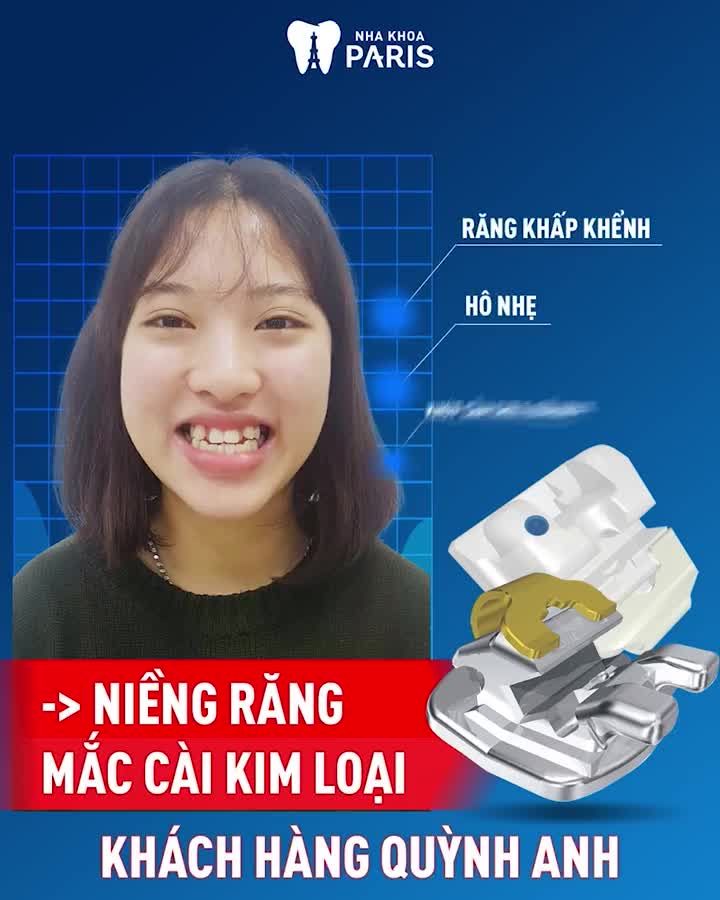 Tháo Niềng Răng Hết Khấp Khểnh, Mặt Vline