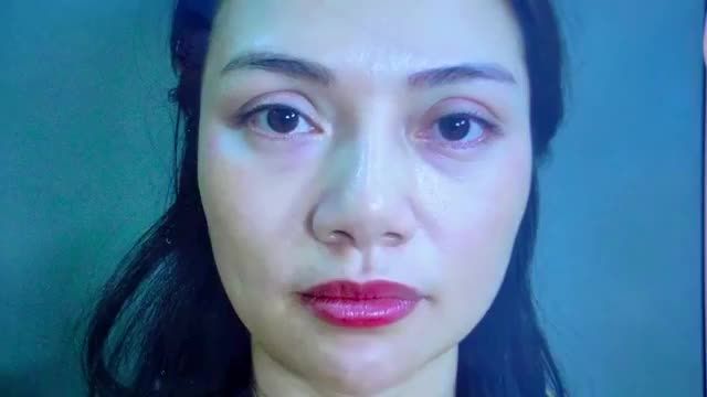 Bác sĩ làm việc xuyên trưa GIẢI CỨU thành công ca mí lỗi hỏng do thực hiện tại cơ sở không uy tín bằng kỹ thuật Sửa mí DeepTech20