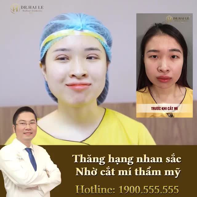 Chỉ với 30 phút cắt mí Thẩm mỹ Tạo ngay nếp mí tròn đều, mềm mại tự nhiên.