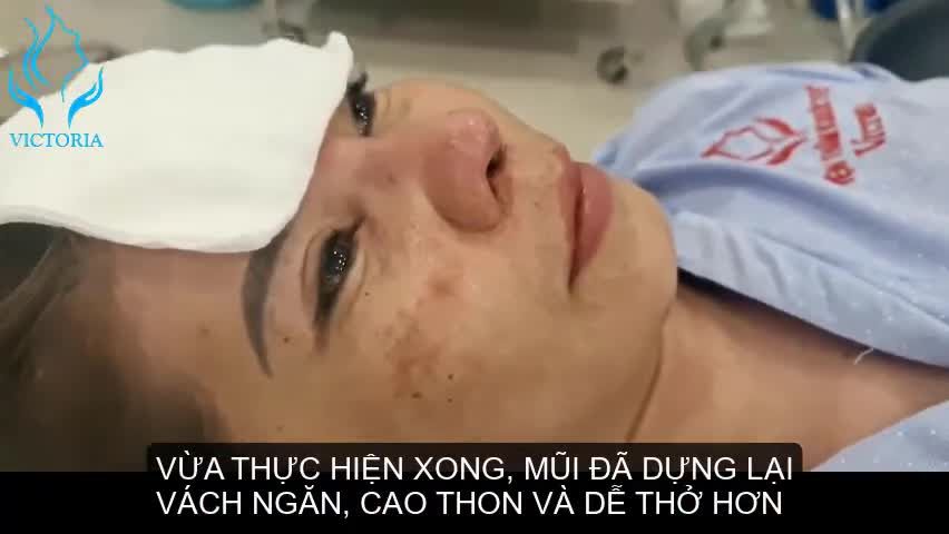 MŨI HỎNG SỬA LẠI 4 LẦN, MŨI CAO THON VÀ DỄ THỞ HƠN NHIỀU