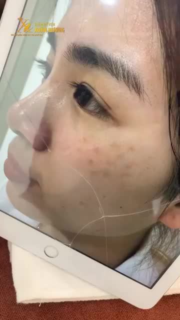 NÁM CHÂN SÂU NỐT TO ĐẬM 2 BÊN GÒ MÁ BỖNG HẾT SẠCH SAU LIỆU TRÌNH NGẮN LẠI XUÂN HƯƠNG