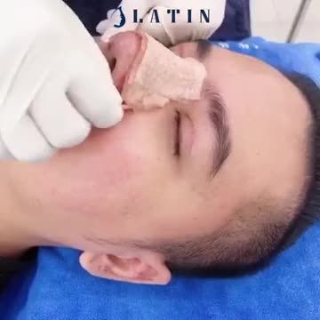 NAM TÍNH - SOÁI CA với combo cắt mí 4D nâng mũi cấu trúc dáng latin Dáng mũi hot trend 2021.