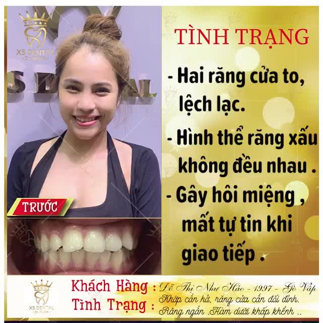 Video cảm nhận của khách hàng : Đỗ Thị Như Thảo 1997 TP HCM. Làm trọn bộ 18 răng sứ Cao cấp tại nha khoa XS .