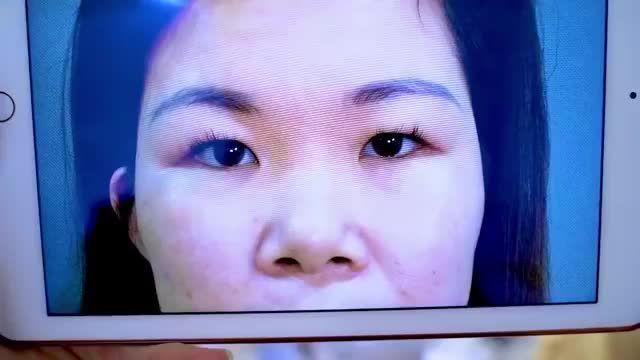 Sự thay đổi ngoạn mục từ đôi mắt nhỏ một mí già nua trở nên tươi trẻ rạng rỡ, sắc nét sau 45 phút thực hiện Cắt mí mk