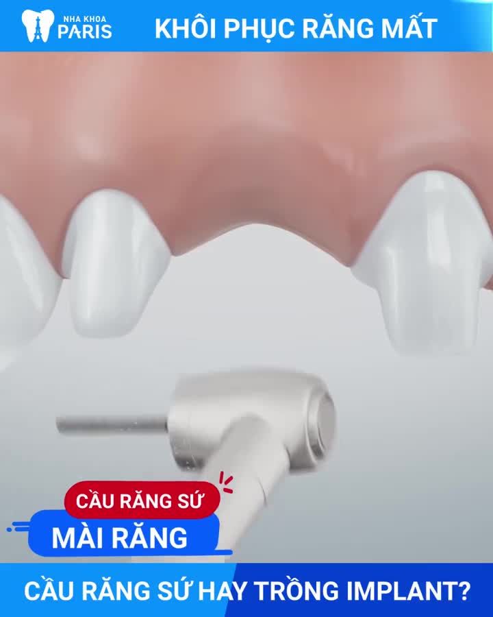 MẤT RĂNG do Tuổi Già Tai Nạn Sâu Vỡ