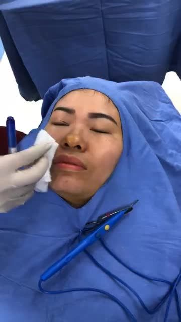 U35 Bọng mỡ + Da chùng + Độ mở mí nhỏ xử lý thế nào?