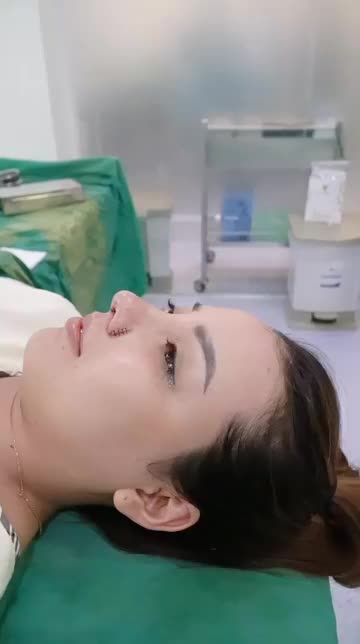 CA NÂNG MŨI CẤU TRÚC SỬA LẠI KẾT HỢP CẮT CÁNH MŨI CUỐI NGÀY VỪA THỰC HIỆN XONG CHO KHÁCH HÀNG THUY DUNG TẠI SAIGON STAR - DR. HOẠT