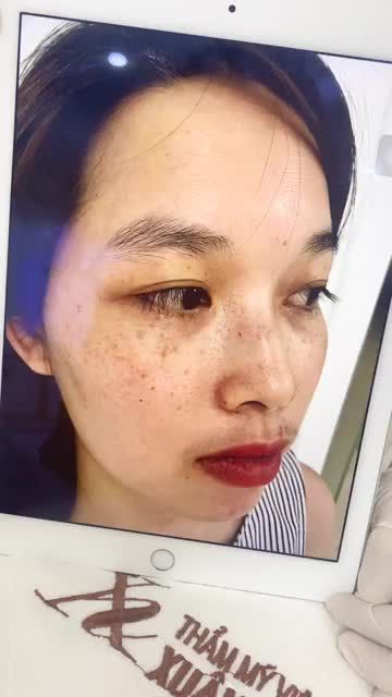 COMBO NÁM + TÀN NHANG “BAY MÀU” SAU 4 BUỔI ĐIỀU TRỊ TẠI TMV XUÂN HƯƠNG NHƯ THẾ NÀO?