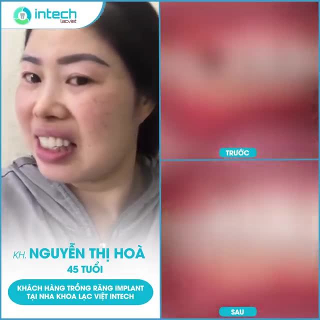 HOÀN THIỆN IMPLANT RĂNG CỬA BẰNG KỸ THUẬT USI HIỆN ĐẠI