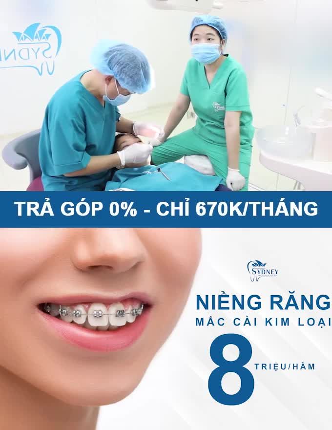 KHẮC PHỤC 3 TÌNH TRẠNG RĂNG CÙNG MẮC CÀI KIM LOẠI