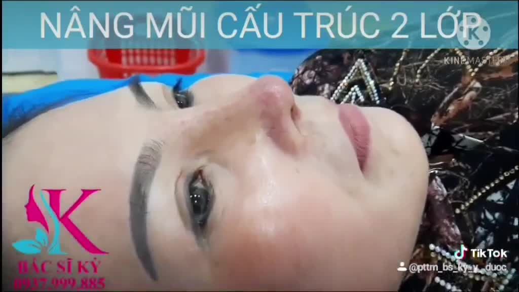 Khách Hàng Tái Khám Sau 10 Ngày NÂNG MŨI CẤU TRÚC 2 LỚP