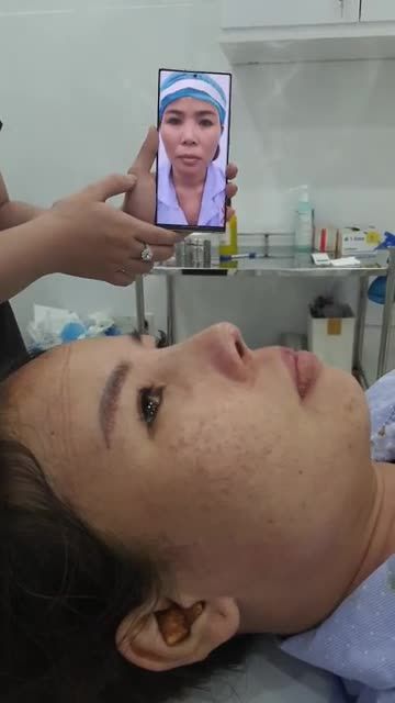NÂNG MŨI BÁN CẤU TRÚC SLINE THAY ĐỔI NHAN SẮC 180 ĐỘ