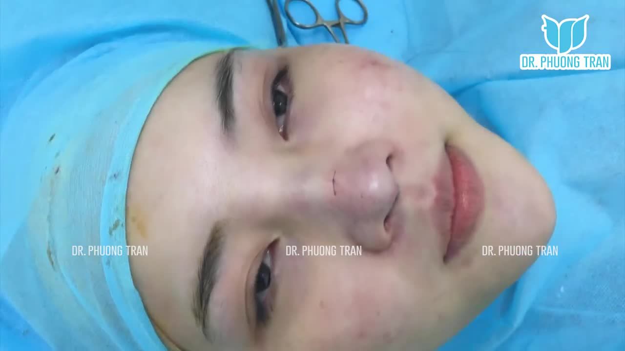 SIÊU PHẨM MŨI CẤU TRÚC SURGIFORM.