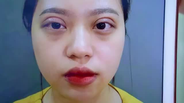 GIẢI CỨU MÍ HỎNG DO PT TẠI SPA KHÔNG UY TÍN - DR HẢI LÊ ĐÃ MANG ĐẾN KẾT QUẢ MÍ ĐẸP XUẤT SẮC NHƯ THẾ NÀO?