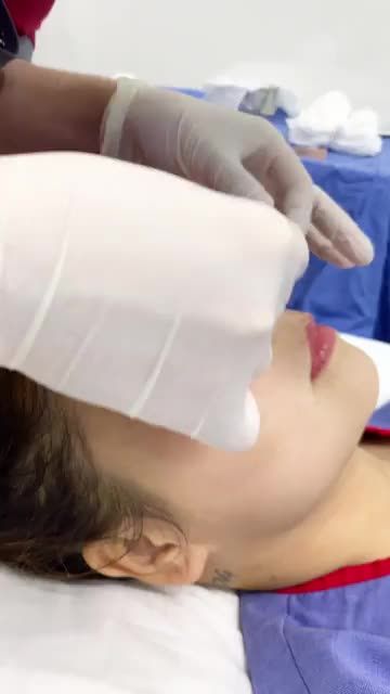Hướng dẫn nẹp mũi - Bước quan trọng bắt buộc phải có sau nâng mũi?