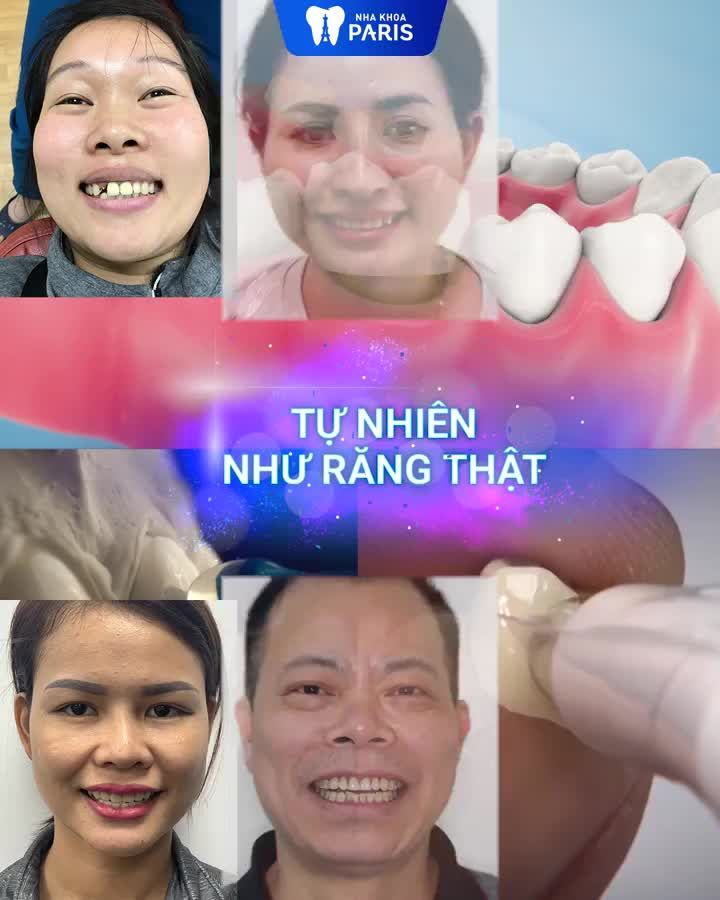 Bọc sứ chuẩn Pháp KHÔNG MÀI NHỎ