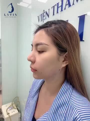 Chỉ mất 30phút là bay hết nọng cằm, cằm lẹm đổi lại một dáng cằm nhỏ gọn, line hàm góc cạnh, tự nhiên.