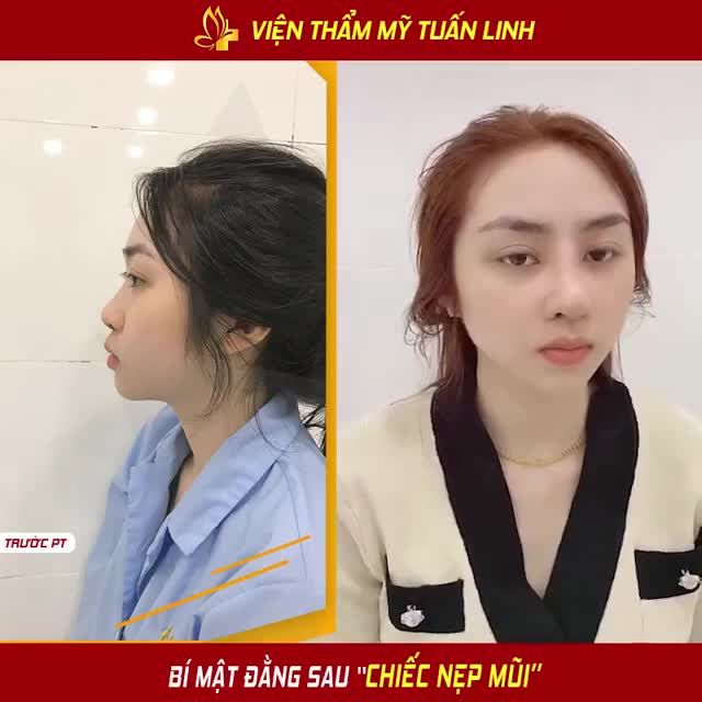 ĐẰNG SAU " CHIẾC NẸP MŨI" LÀ GÌ ????