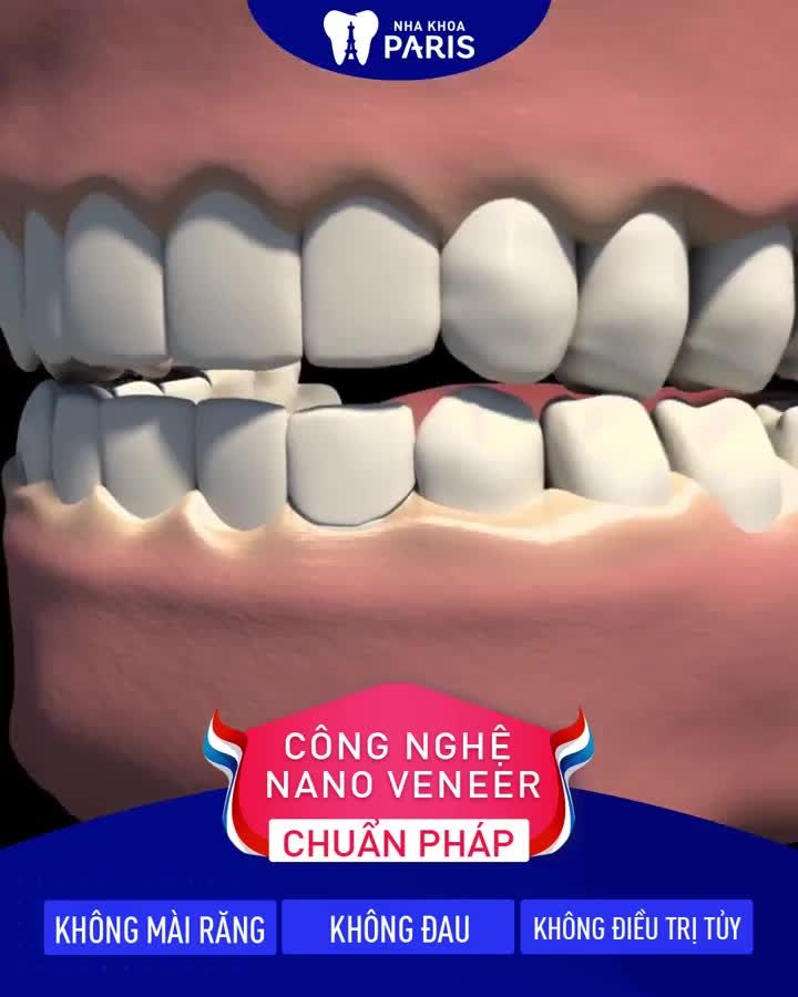 Dán Sứ Veneer Răng Hết Sứt Mẻ, Thưa, Ố Vàng