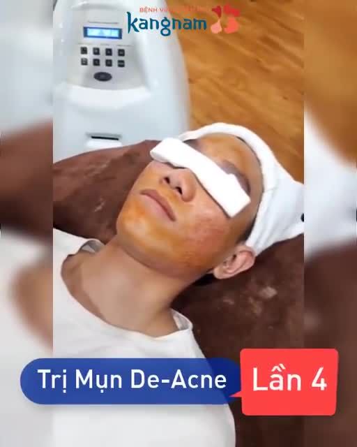 Ngạc nhiên chưa  Buổi thứ 4 trị mụn Công nghệ cao De-Acne