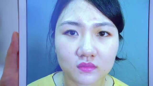 Cắt mí không đau - Ít sưng - Bình phục nhanh - Nếp mí đẹp tự nhiên hài hòa khẳng định chỉ có tại Dr.Hải Lê